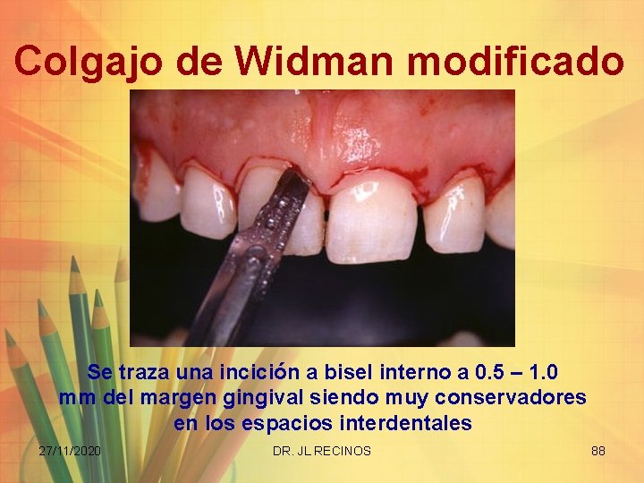 Colgajo de Widman modificado Se traza una incición a bisel interno a 0. 5