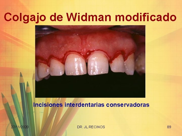 Colgajo de Widman modificado Incisiones interdentarias conservadoras 27/11/2020 DR. JL RECINOS 89 