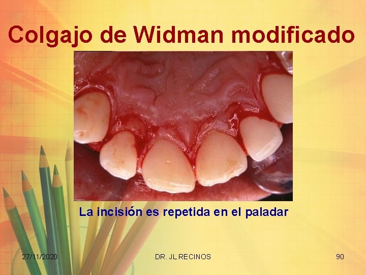 Colgajo de Widman modificado La incisión es repetida en el paladar 27/11/2020 DR. JL