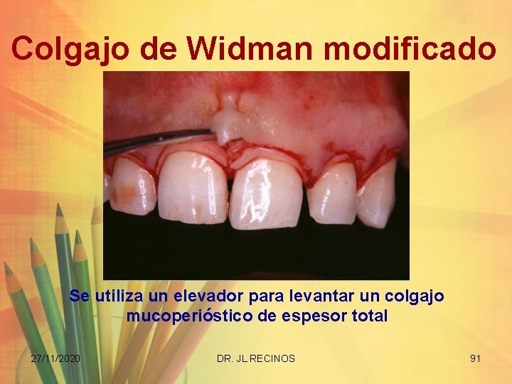 Colgajo de Widman modificado Se utiliza un elevador para levantar un colgajo mucoperióstico de