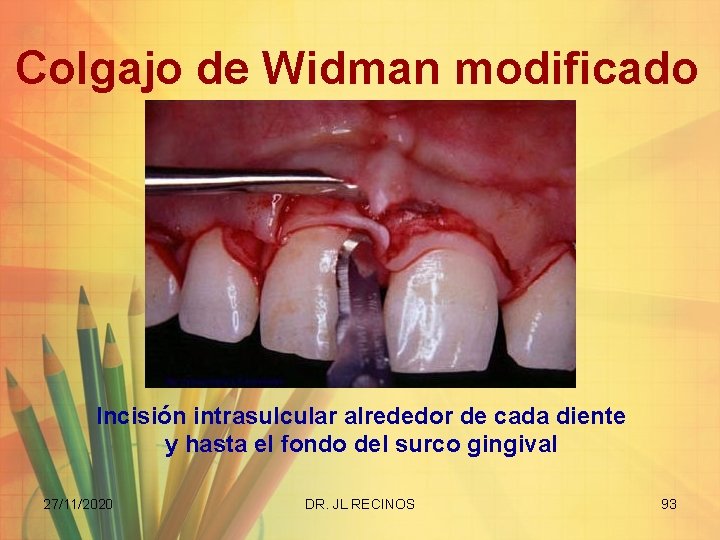 Colgajo de Widman modificado Incisión intrasulcular alrededor de cada diente y hasta el fondo