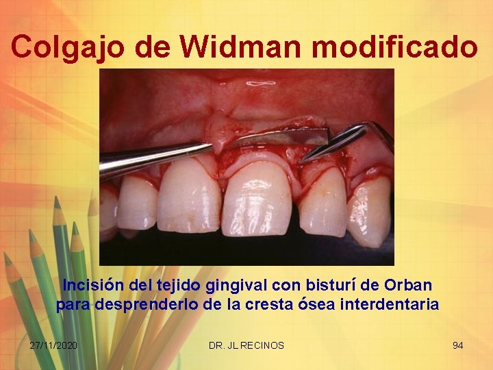 Colgajo de Widman modificado Incisión del tejido gingival con bisturí de Orban para desprenderlo