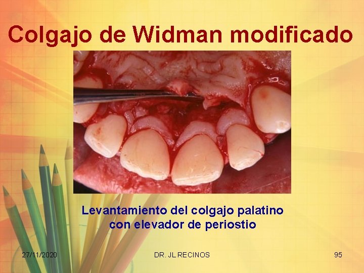 Colgajo de Widman modificado Levantamiento del colgajo palatino con elevador de periostio 27/11/2020 DR.