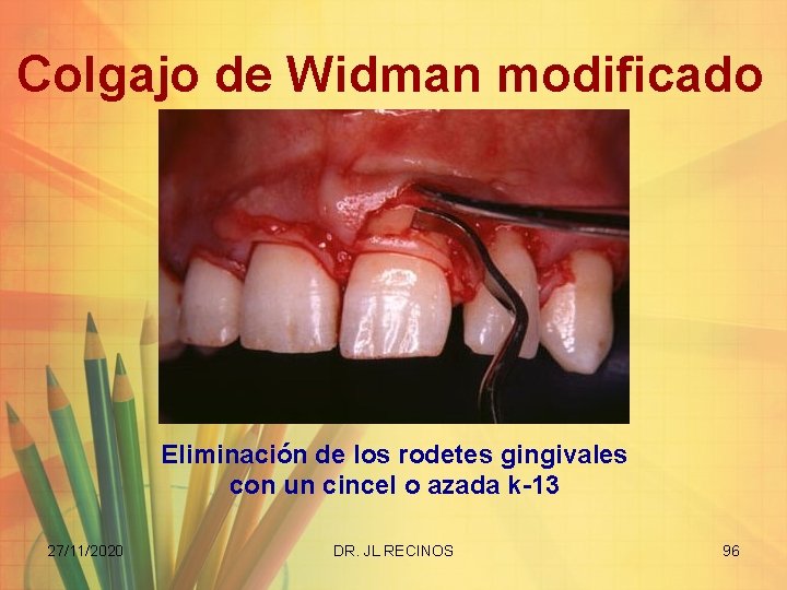 Colgajo de Widman modificado Eliminación de los rodetes gingivales con un cincel o azada