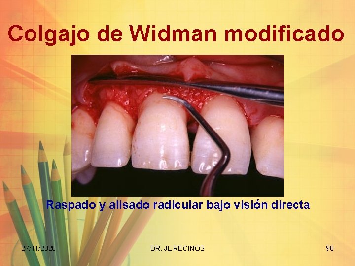 Colgajo de Widman modificado Raspado y alisado radicular bajo visión directa 27/11/2020 DR. JL