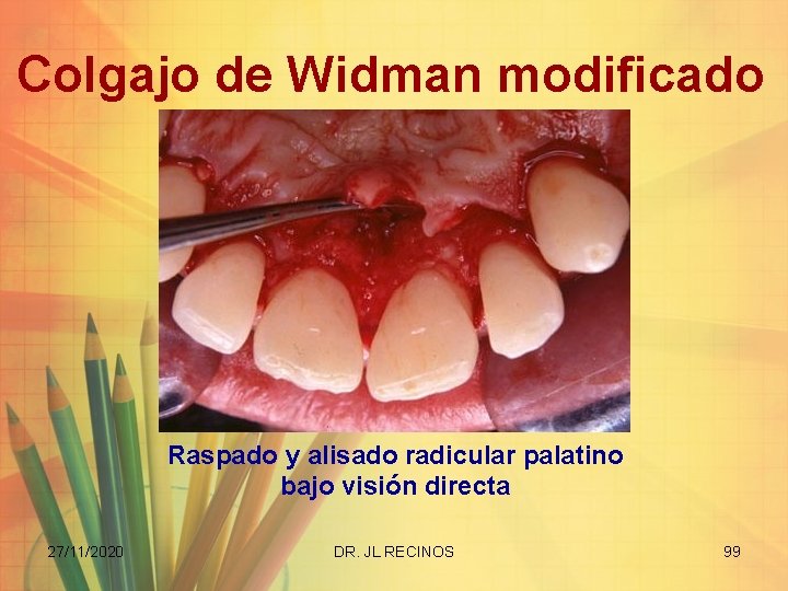 Colgajo de Widman modificado Raspado y alisado radicular palatino bajo visión directa 27/11/2020 DR.