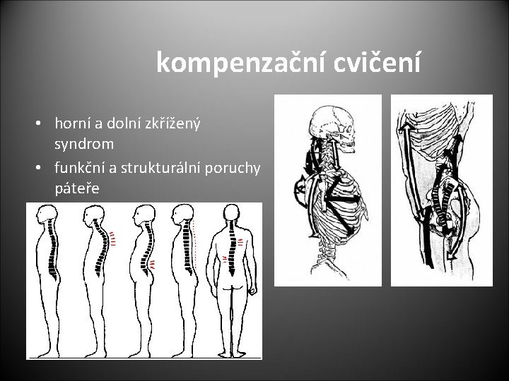 kompenzační cvičení • horní a dolní zkřížený syndrom • funkční a strukturální poruchy páteře