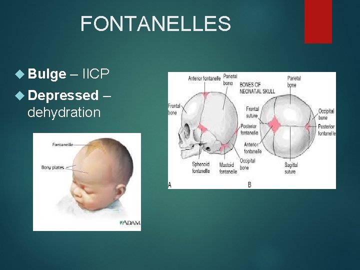 FONTANELLES Bulge – IICP Depressed – dehydration 