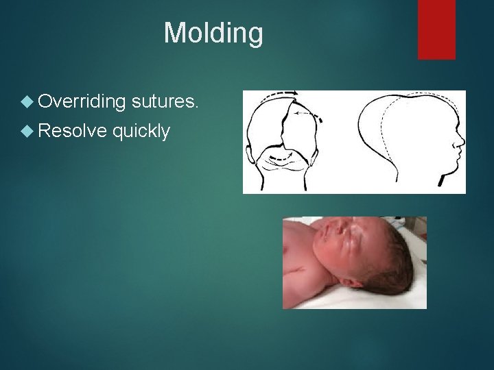 Molding Overriding sutures. Resolve quickly 