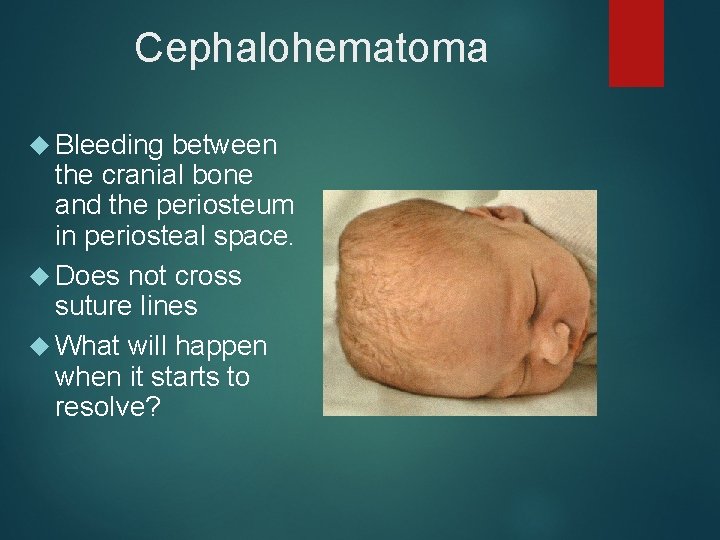 Cephalohematoma Bleeding between the cranial bone and the periosteum in periosteal space. Does not