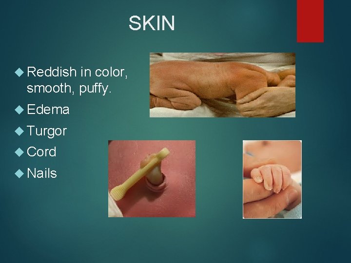 SKIN Reddish in color, smooth, puffy. Edema Turgor Cord Nails 