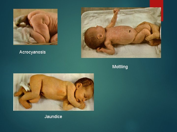 Acrocyanosis Mottling Jaundice 