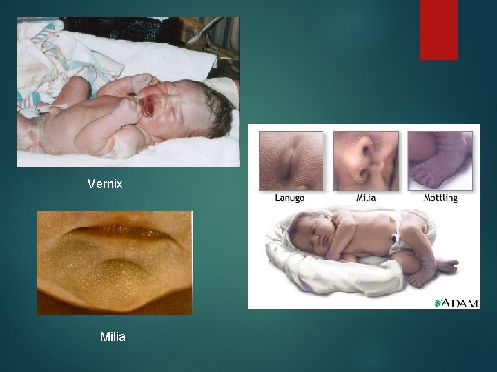 Vernix Milia 