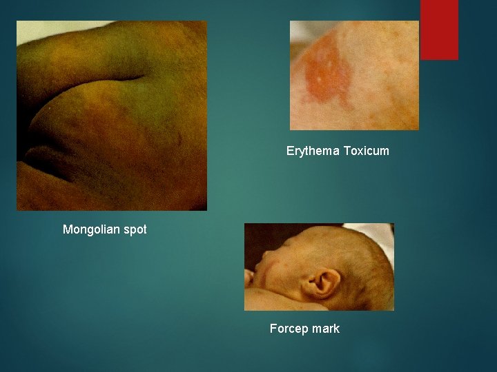 Erythema Toxicum Mongolian spot Forcep mark 