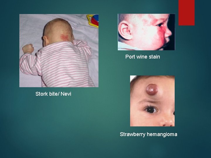 Port wine stain Stork bite/ Nevi Strawberry hemangioma 