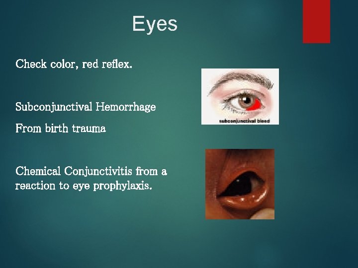 Eyes Check color, red reflex. Subconjunctival Hemorrhage From birth trauma Chemical Conjunctivitis from a