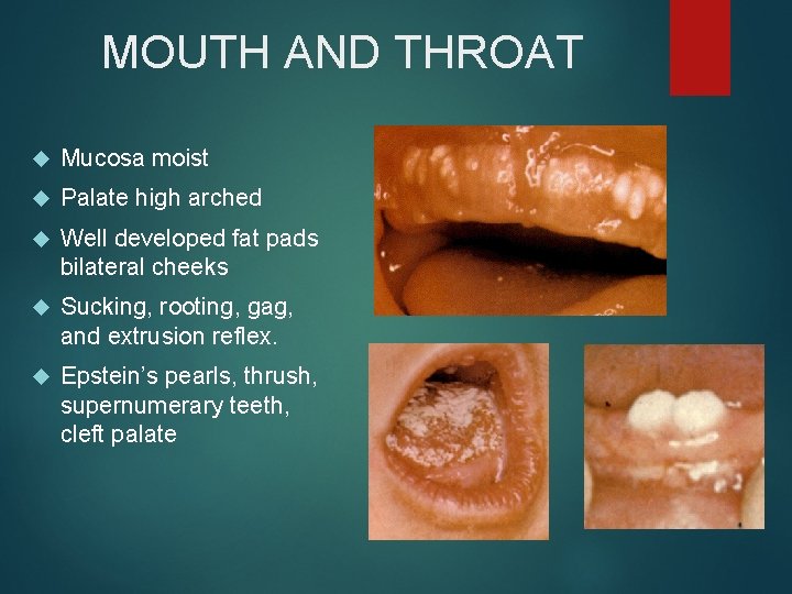 MOUTH AND THROAT Mucosa moist Palate high arched Well developed fat pads bilateral cheeks