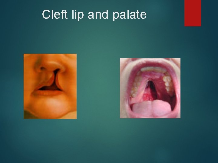 Cleft lip and palate 