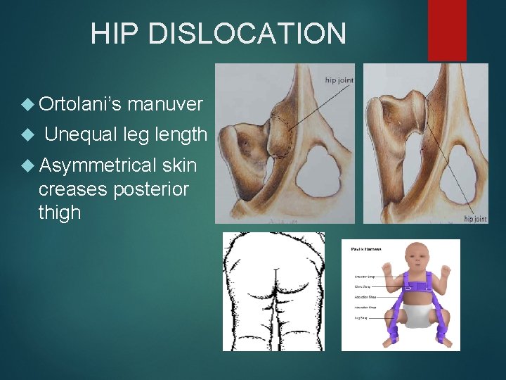 HIP DISLOCATION Ortolani’s manuver Unequal leg length Asymmetrical skin creases posterior thigh 