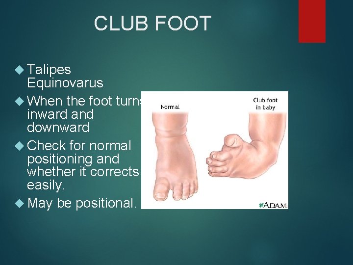 CLUB FOOT Talipes Equinovarus When the foot turns inward and downward Check for normal