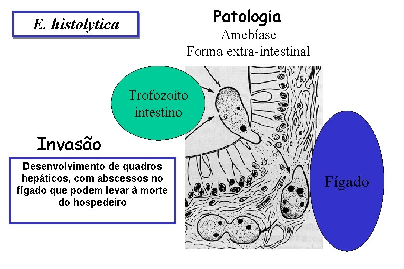 Patologia E. histolytica Amebíase Forma extra-intestinal Trofozoíto intestino Invasão Desenvolvimento de quadros hepáticos, com