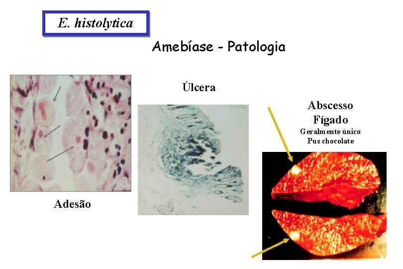 E. histolytica Amebíase - Patologia Úlcera Abscesso Fígado Geralmente único Pus chocolate Adesão 