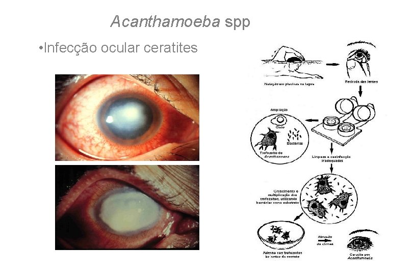 Acanthamoeba spp • Infecção ocular ceratites 