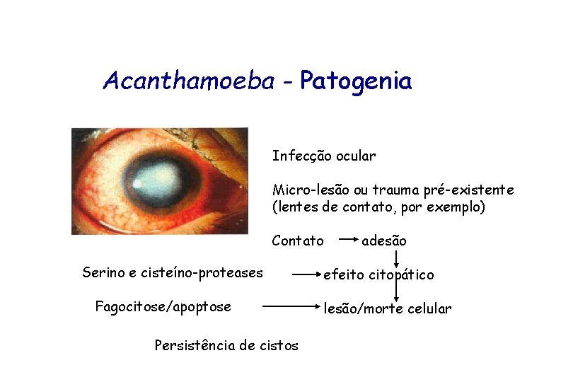 Acanthamoeba - Patogenia Infecção ocular Micro-lesão ou trauma pré-existente (lentes de contato, por exemplo)