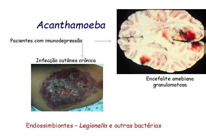 Acanthamoeba Pacientes com imunodepressão Infecção cutânea crônica Encefalite amebiana granulomatosa Endossimbiontes – Legionella e
