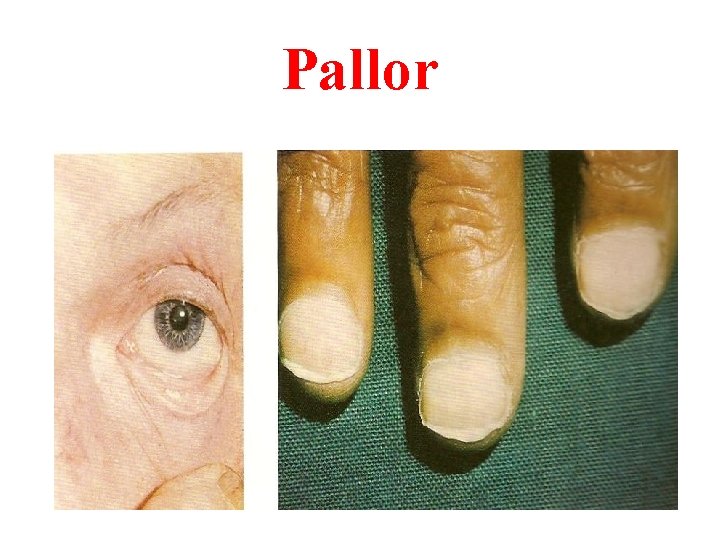 Pallor 