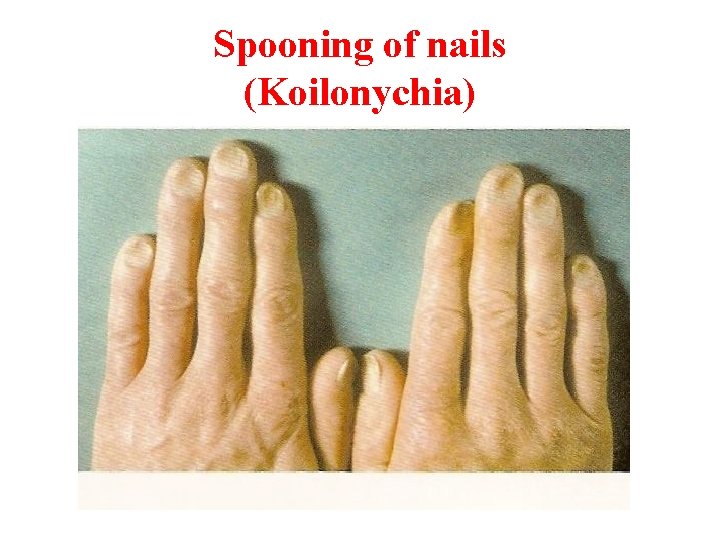 Spooning of nails (Koilonychia) 