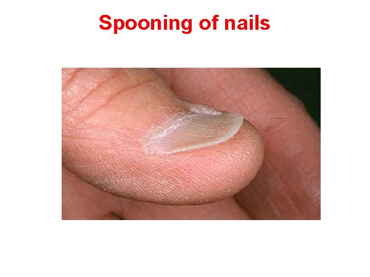 Spooning of nails 