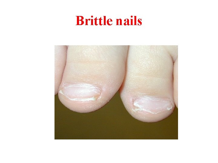 Brittle nails 