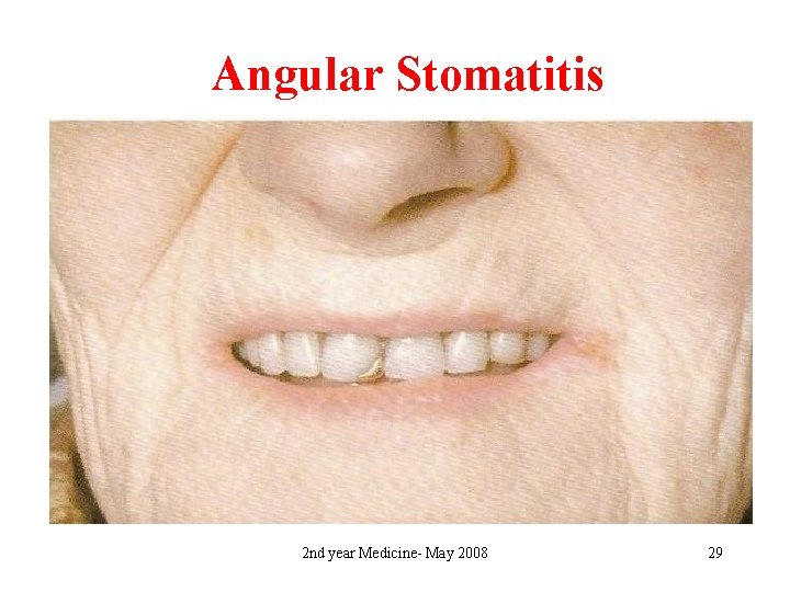  Angular Stomatitis 2 nd year Medicine- May 2008 29 