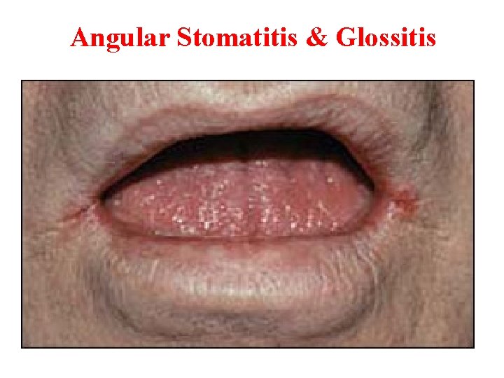  Angular Stomatitis & Glossitis 