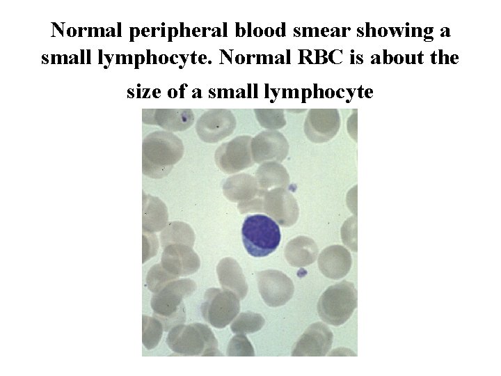 Normal peripheral blood smear showing a small lymphocyte. Normal RBC is about the size