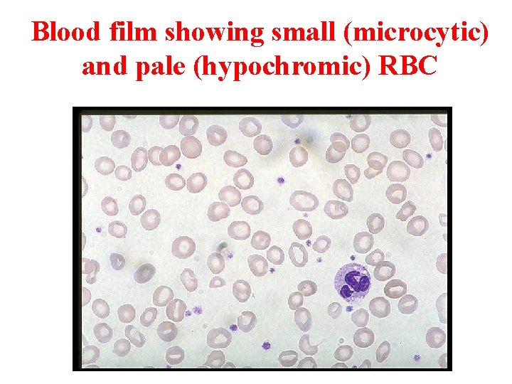 Blood film showing small (microcytic) and pale (hypochromic) RBC 