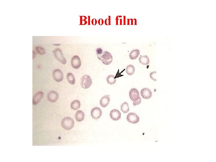 Blood film 