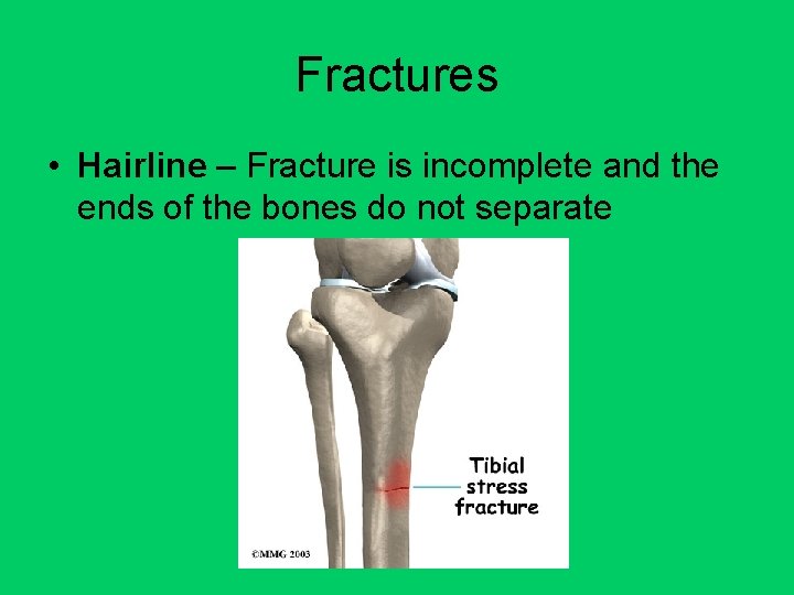 Fractures • Hairline – Fracture is incomplete and the ends of the bones do