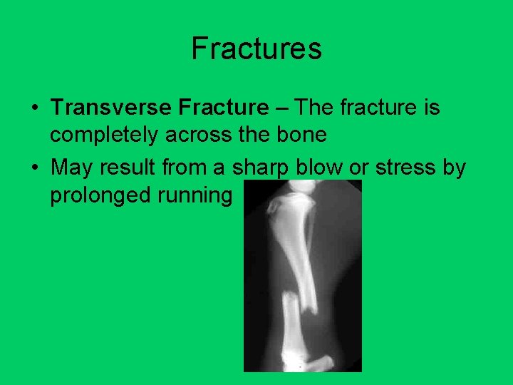 Fractures • Transverse Fracture – The fracture is completely across the bone • May