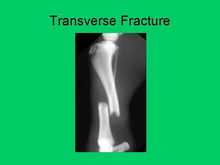 Transverse Fracture 