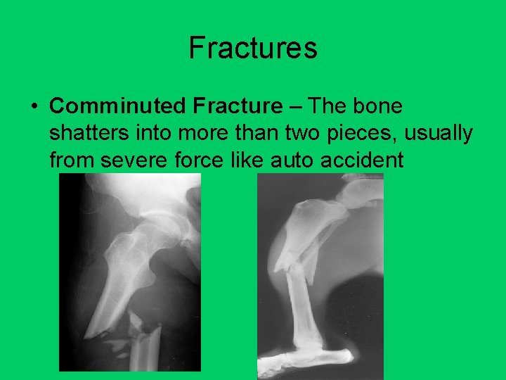 Fractures • Comminuted Fracture – The bone shatters into more than two pieces, usually