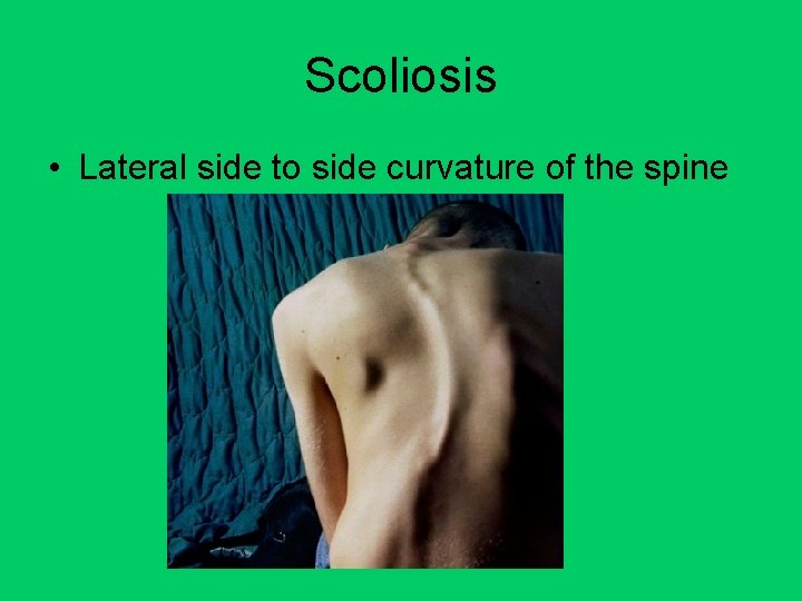 Scoliosis • Lateral side to side curvature of the spine 