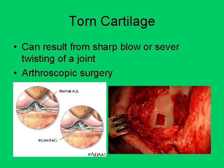 Torn Cartilage • Can result from sharp blow or sever twisting of a joint