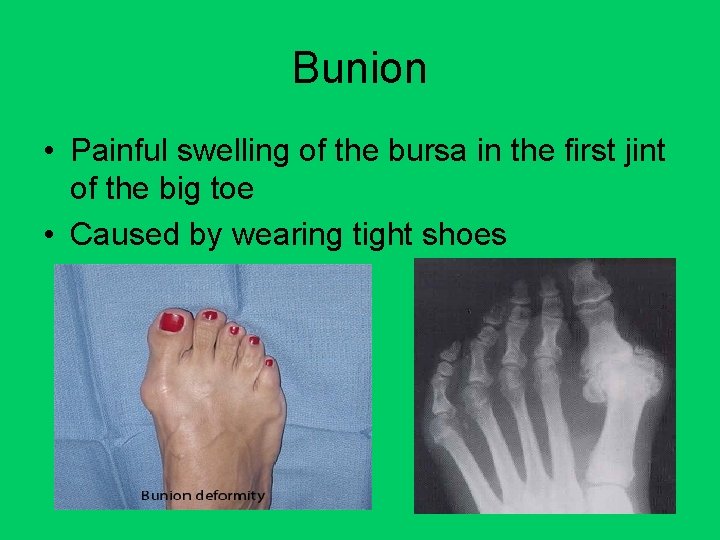 Bunion • Painful swelling of the bursa in the first jint of the big