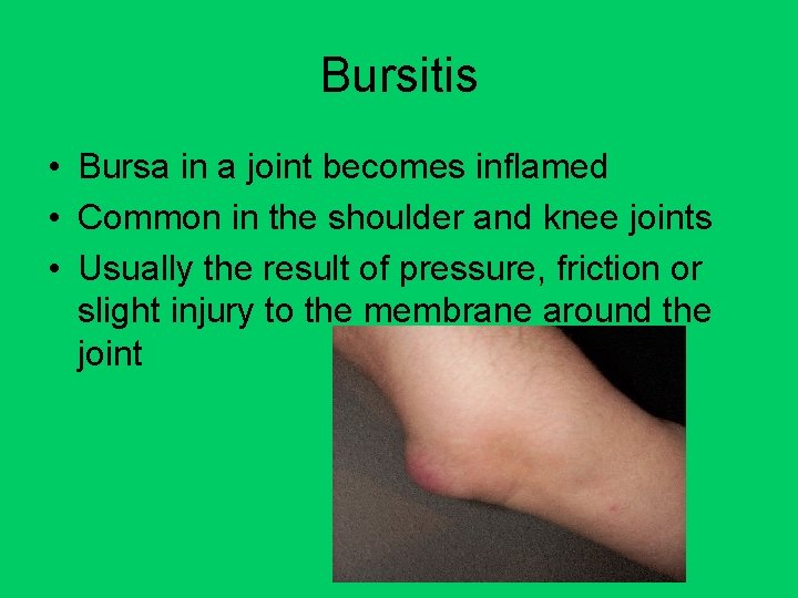 Bursitis • Bursa in a joint becomes inflamed • Common in the shoulder and