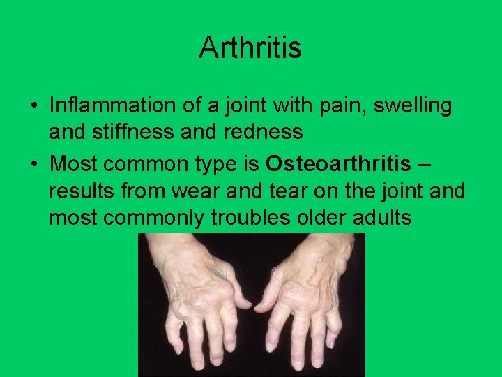 Arthritis • Inflammation of a joint with pain, swelling and stiffness and redness •