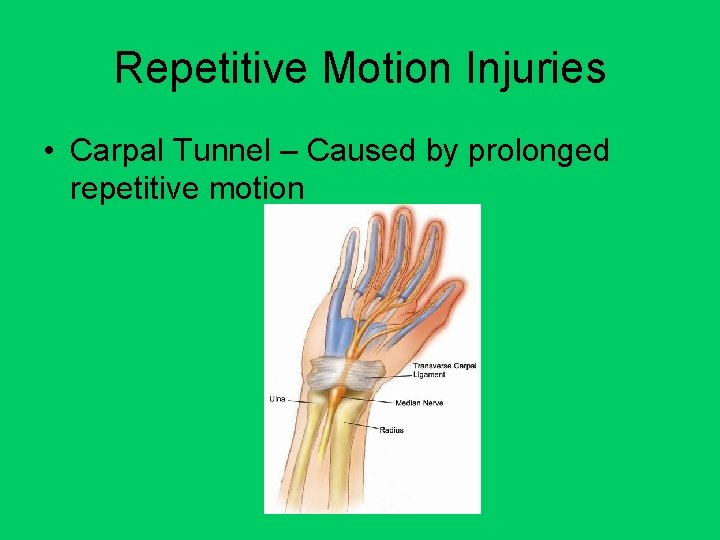 Repetitive Motion Injuries • Carpal Tunnel – Caused by prolonged repetitive motion 