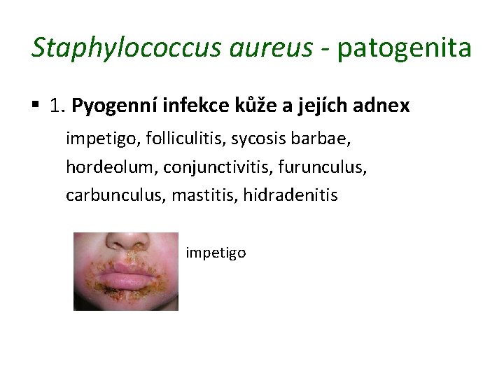 Staphylococcus aureus - patogenita § 1. Pyogenní infekce kůže a jejích adnex impetigo, folliculitis,