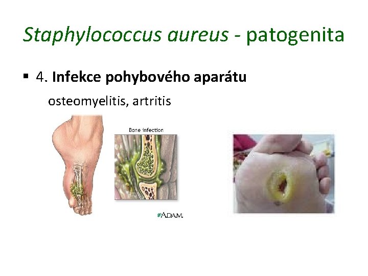 Staphylococcus aureus - patogenita § 4. Infekce pohybového aparátu osteomyelitis, artritis 